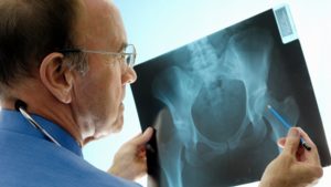 Xray_osteoporosis
